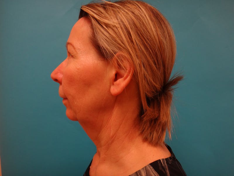 Blepharoplasty Before & After Gallery - Patient 293655 - Image 8