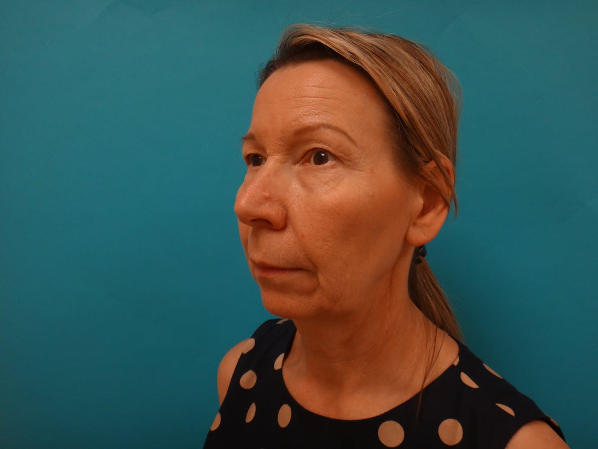 Blepharoplasty Before & After Gallery - Patient 241936 - Image 9