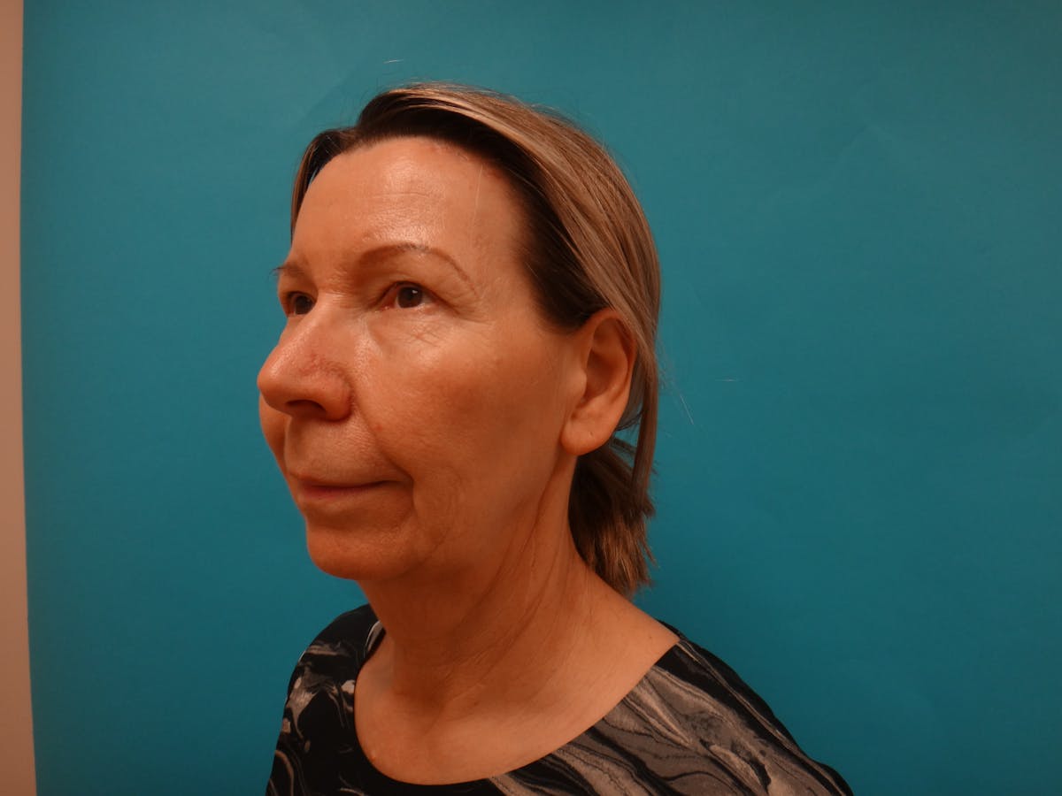 Blepharoplasty Before & After Gallery - Patient 241936 - Image 10
