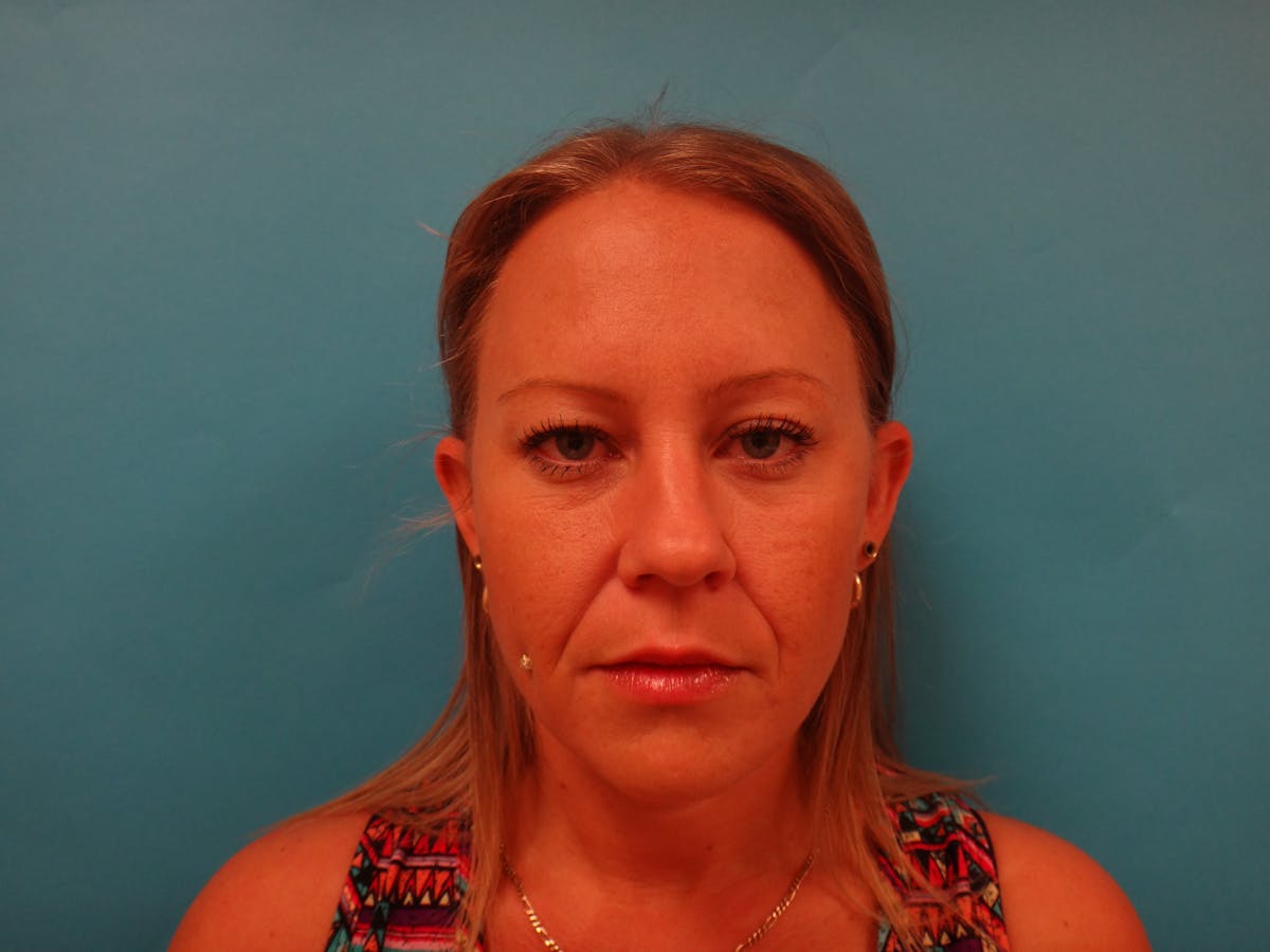 Blepharoplasty Before & After Gallery - Patient 416334 - Image 1