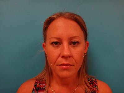 Blepharoplasty Before & After Gallery - Patient 161966 - Image 1