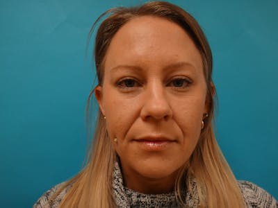 Blepharoplasty Before & After Gallery - Patient 416334 - Image 2