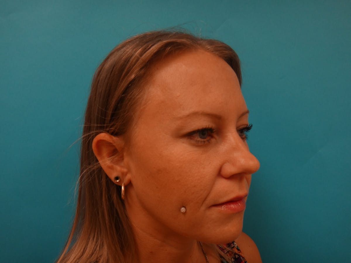 Blepharoplasty Before & After Gallery - Patient 416334 - Image 3