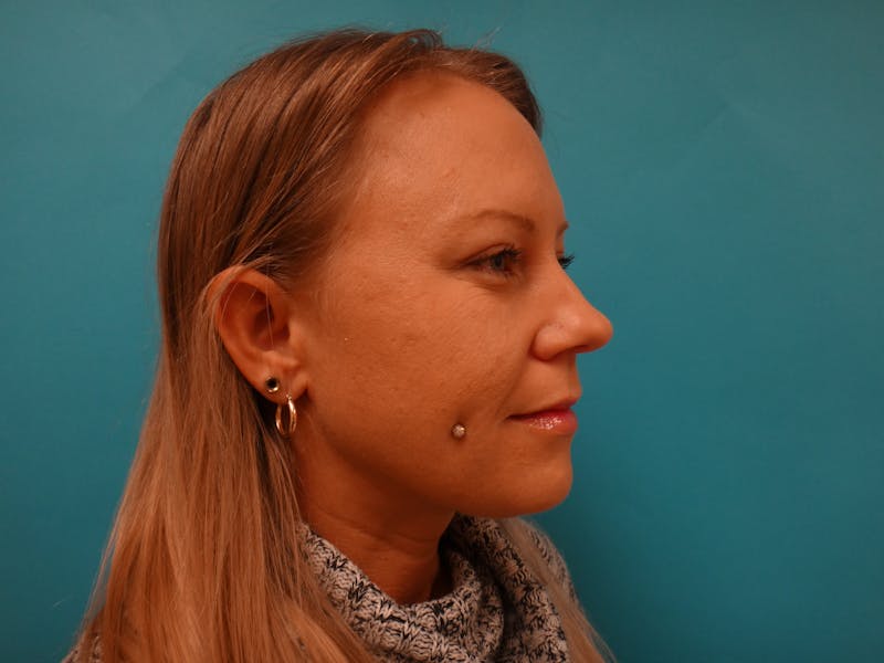 Blepharoplasty Before & After Gallery - Patient 416334 - Image 4