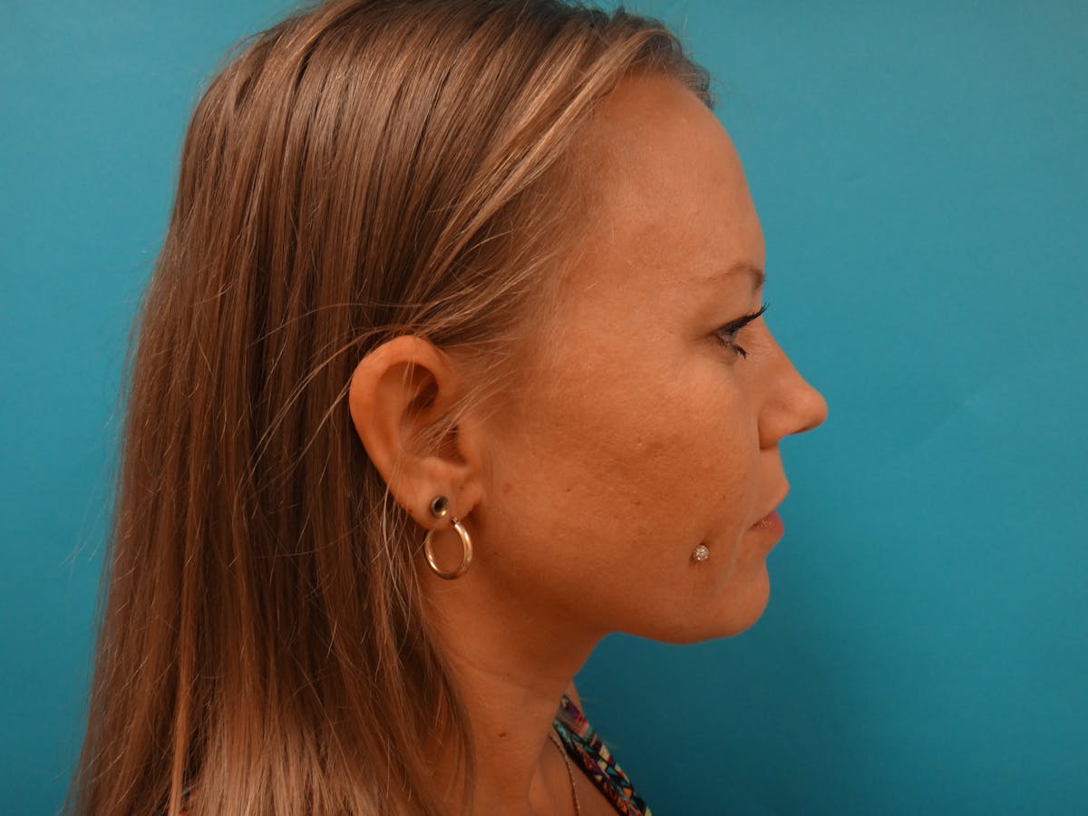 Blepharoplasty Before & After Gallery - Patient 416334 - Image 5