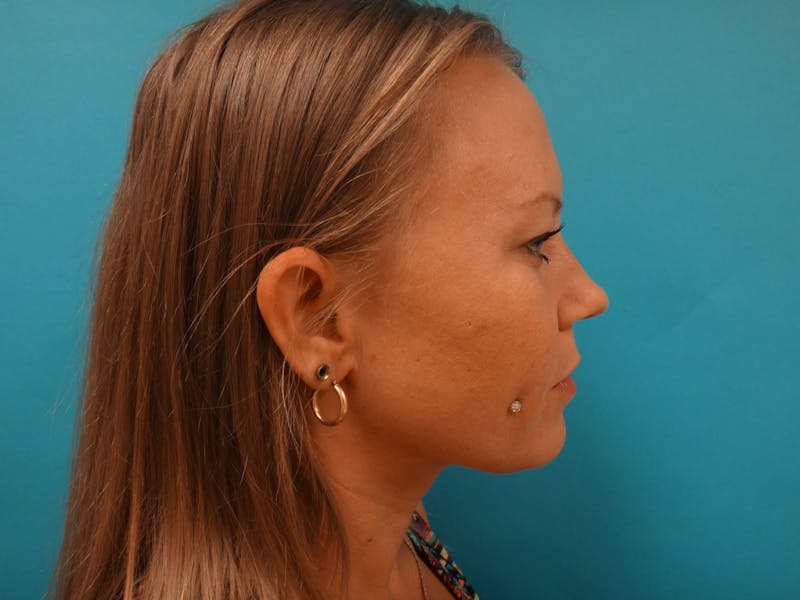 Blepharoplasty Before & After Gallery - Patient 416334 - Image 5