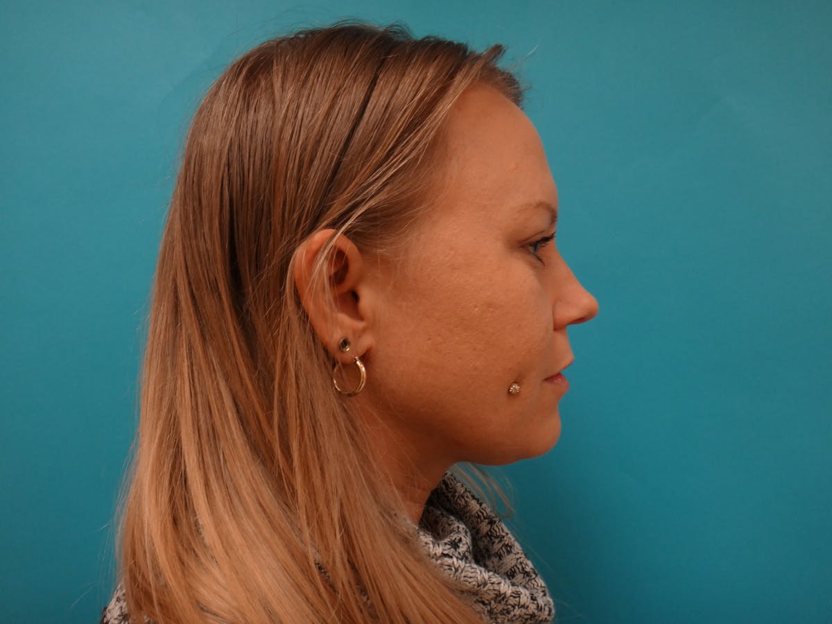 Blepharoplasty Before & After Gallery - Patient 416334 - Image 6