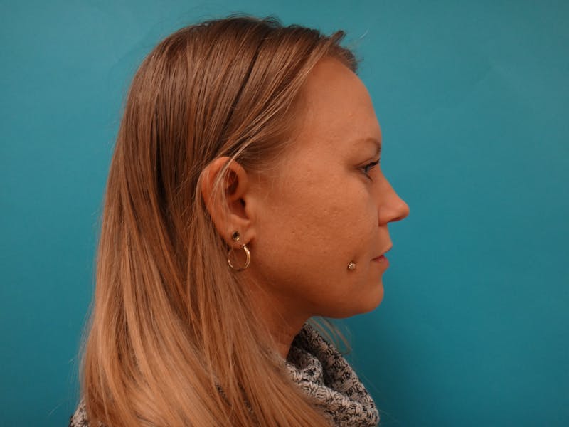 Blepharoplasty Before & After Gallery - Patient 416334 - Image 6