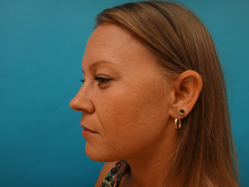 Blepharoplasty Before & After Gallery - Patient 416334 - Image 7