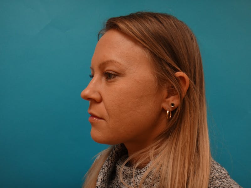 Blepharoplasty Before & After Gallery - Patient 416334 - Image 8