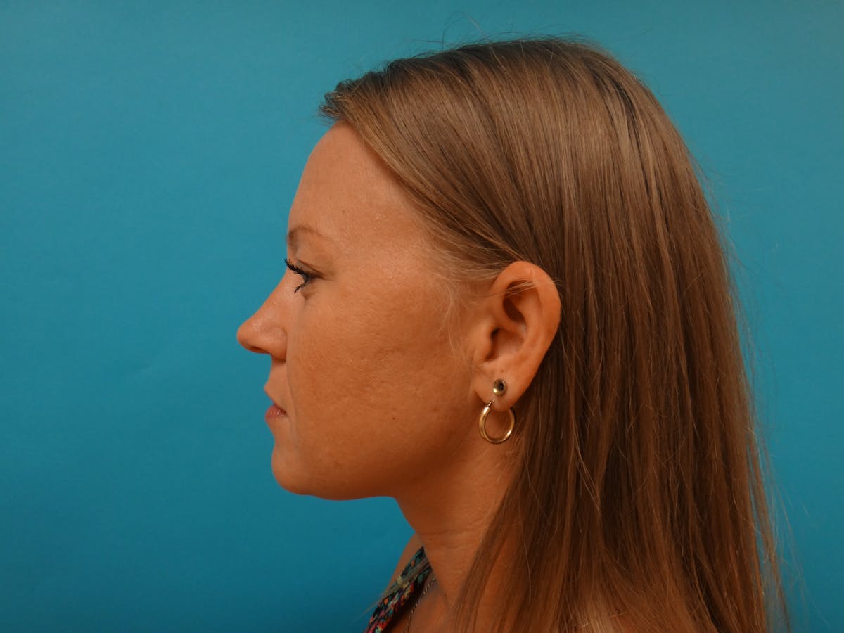 Blepharoplasty Before & After Gallery - Patient 416334 - Image 9