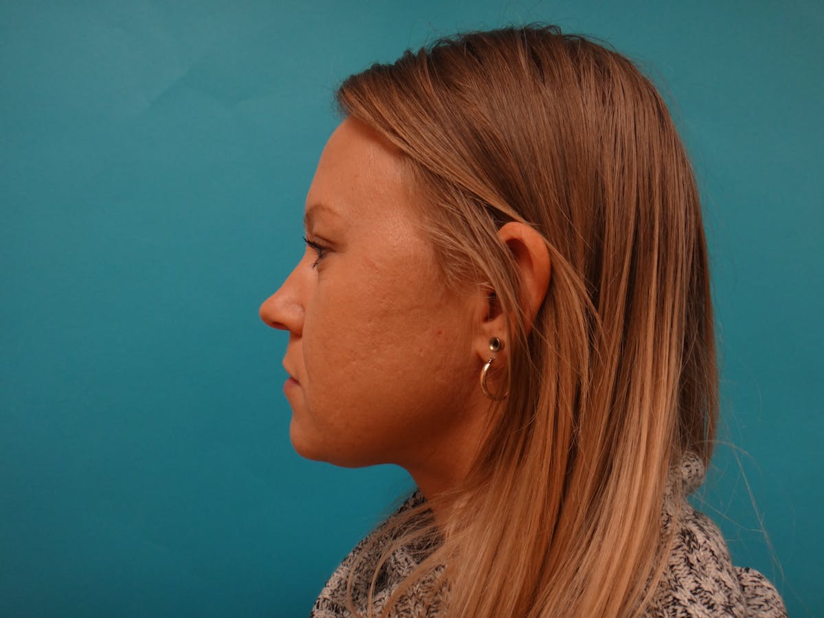 Blepharoplasty Before & After Gallery - Patient 416334 - Image 10