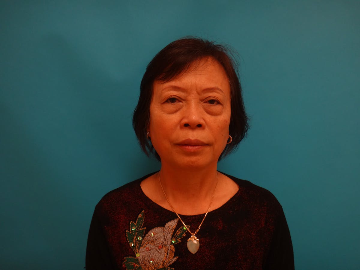 Blepharoplasty Before & After Gallery - Patient 116809 - Image 1