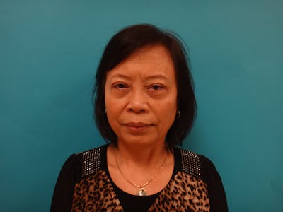 Blepharoplasty Before & After Gallery - Patient 388345 - Image 2