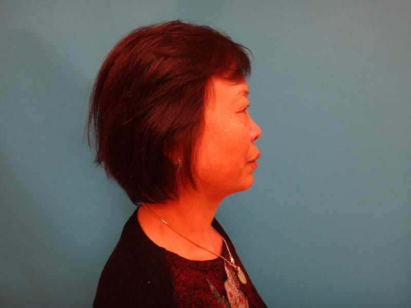 Blepharoplasty Before & After Gallery - Patient 388345 - Image 3