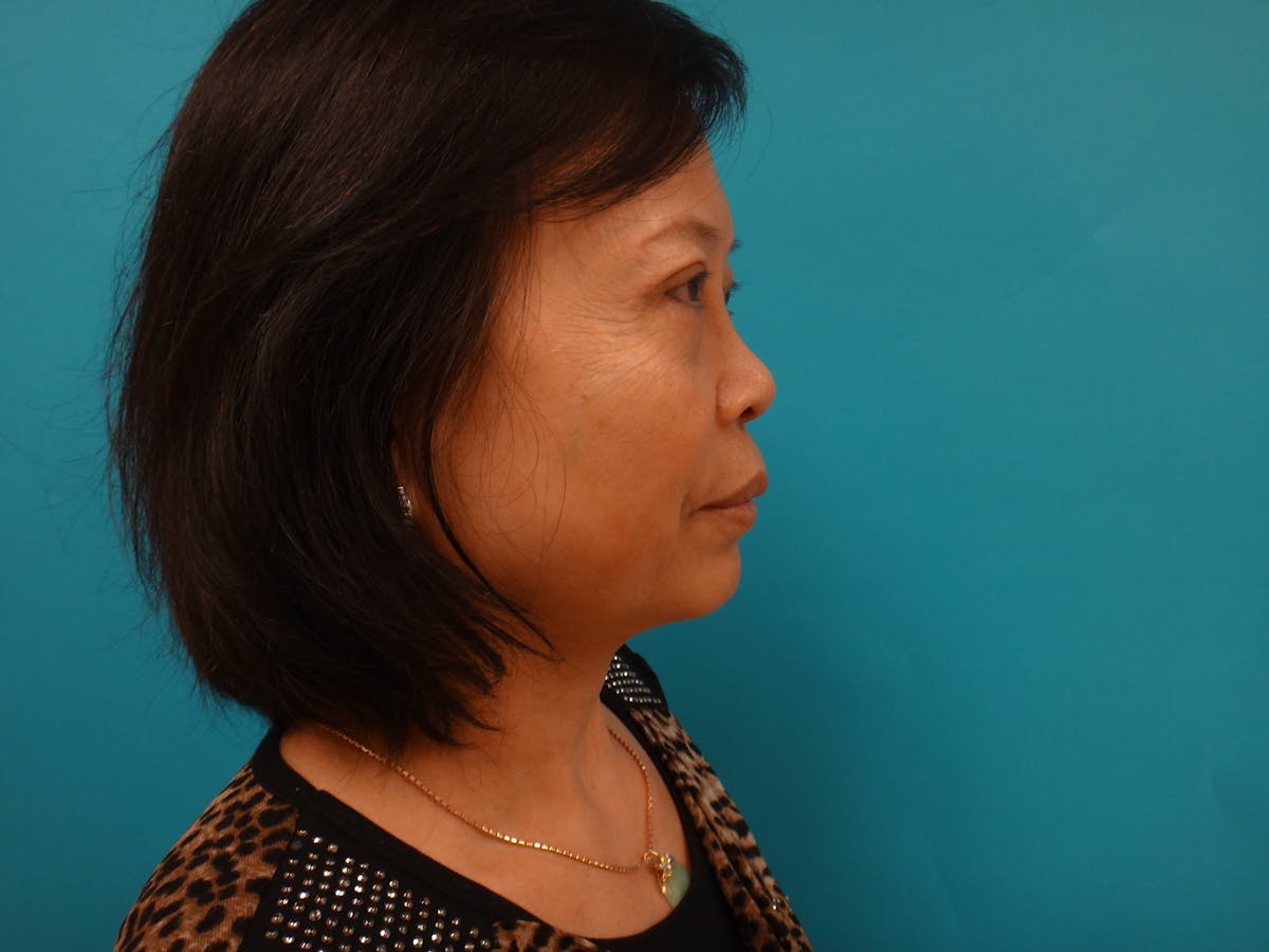 Blepharoplasty Before & After Gallery - Patient 116809 - Image 4