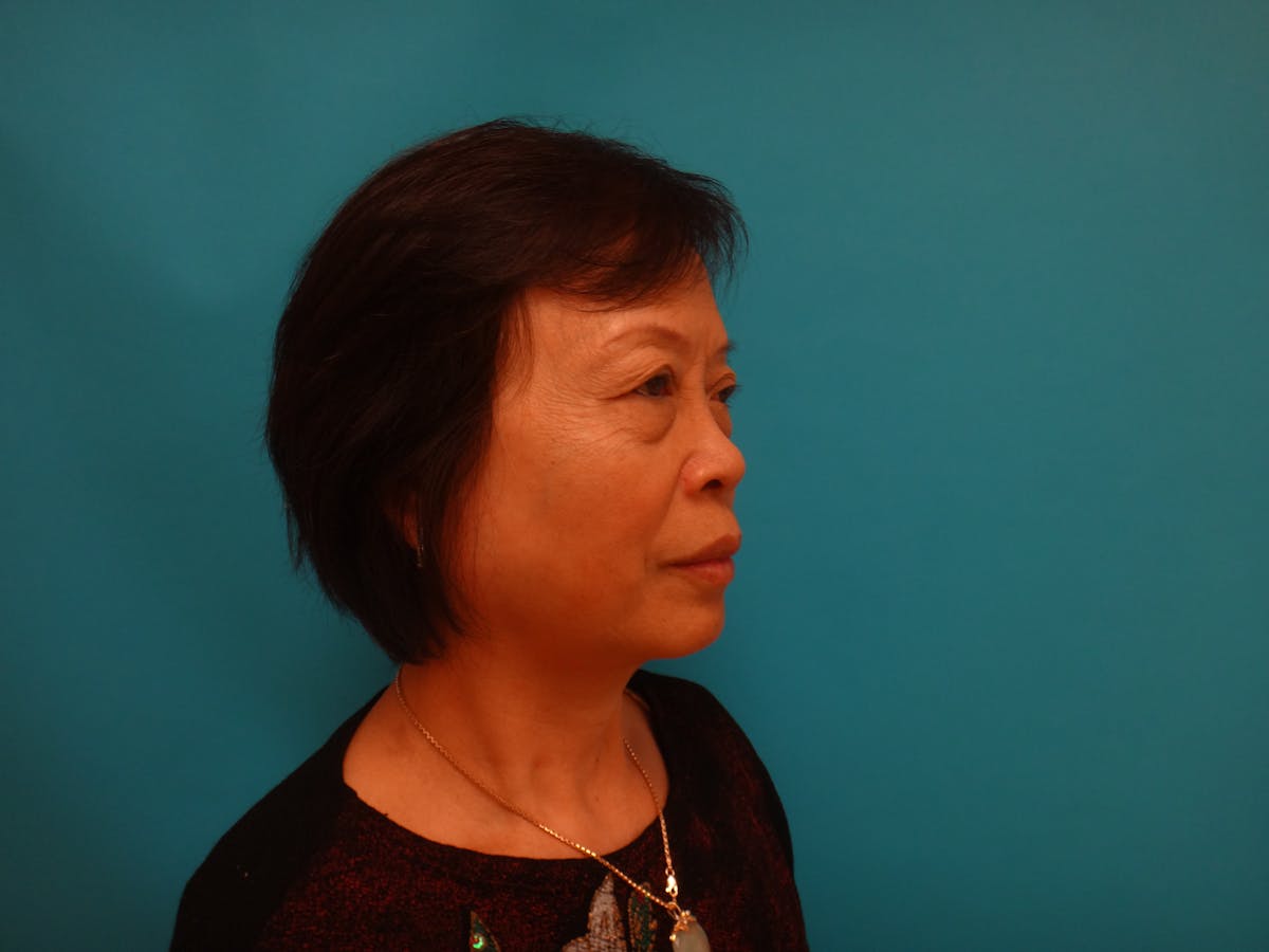 Blepharoplasty Before & After Gallery - Patient 116809 - Image 5