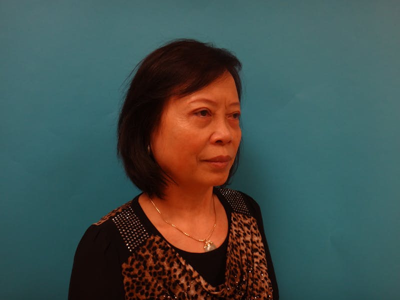 Blepharoplasty Before & After Gallery - Patient 388345 - Image 6