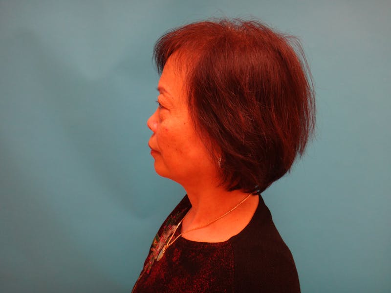 Blepharoplasty Before & After Gallery - Patient 388345 - Image 7