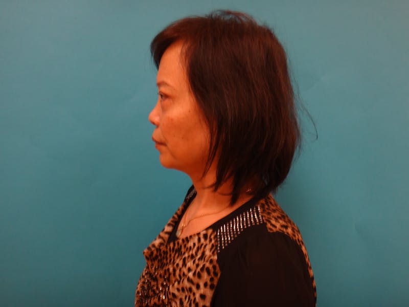 Blepharoplasty Before & After Gallery - Patient 388345 - Image 8