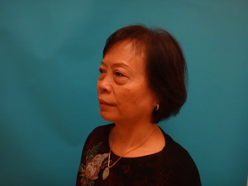 Blepharoplasty Before & After Gallery - Patient 388345 - Image 9