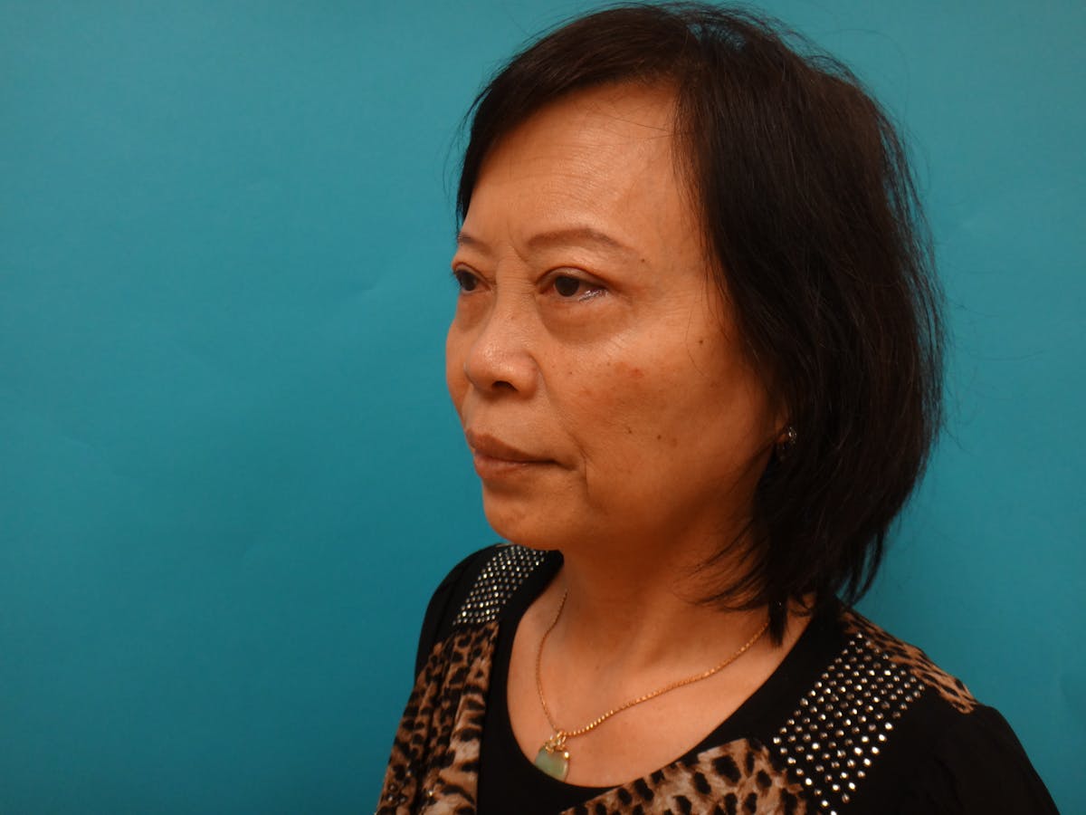 Blepharoplasty Before & After Gallery - Patient 116809 - Image 10