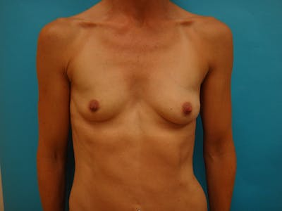 Breast Augmentation Before & After Gallery - Patient 117627 - Image 1