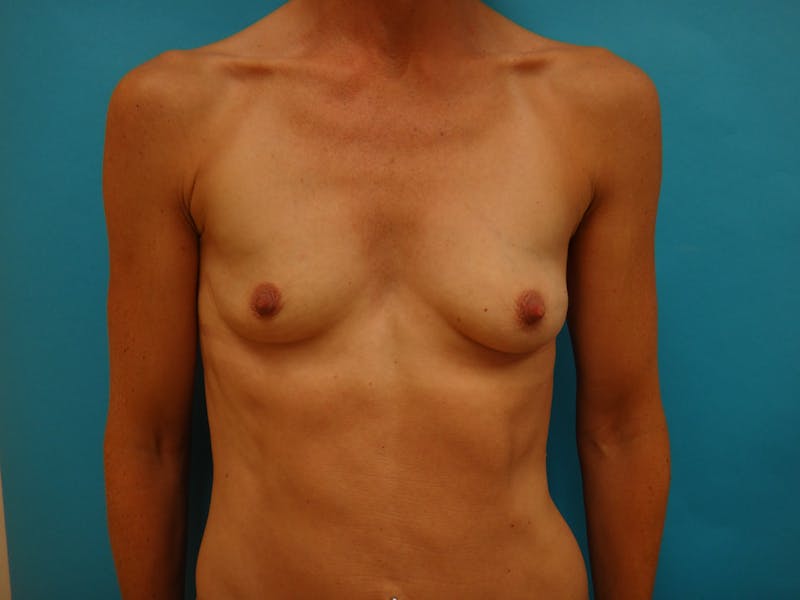 Breast Augmentation Before & After Gallery - Patient 117627 - Image 1