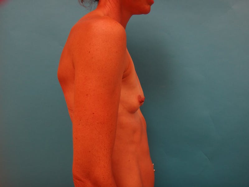 Breast Augmentation Before & After Gallery - Patient 117627 - Image 5