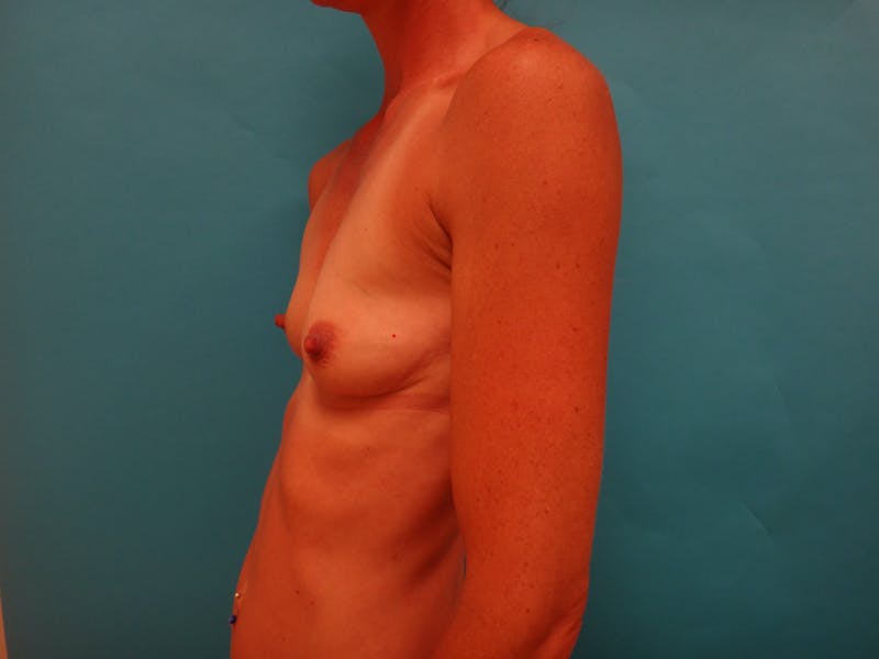Breast Augmentation Before & After Gallery - Patient 117627 - Image 7