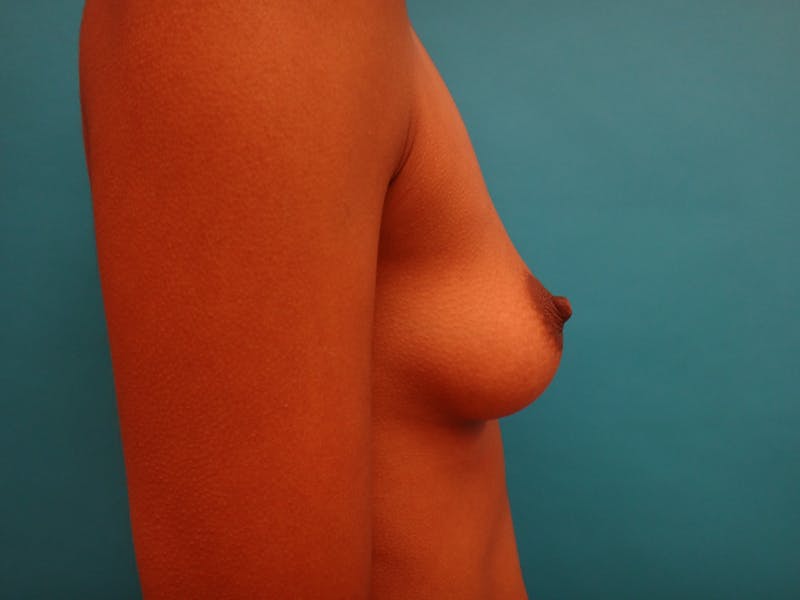 Breast Augmentation Before & After Gallery - Patient 366682 - Image 5
