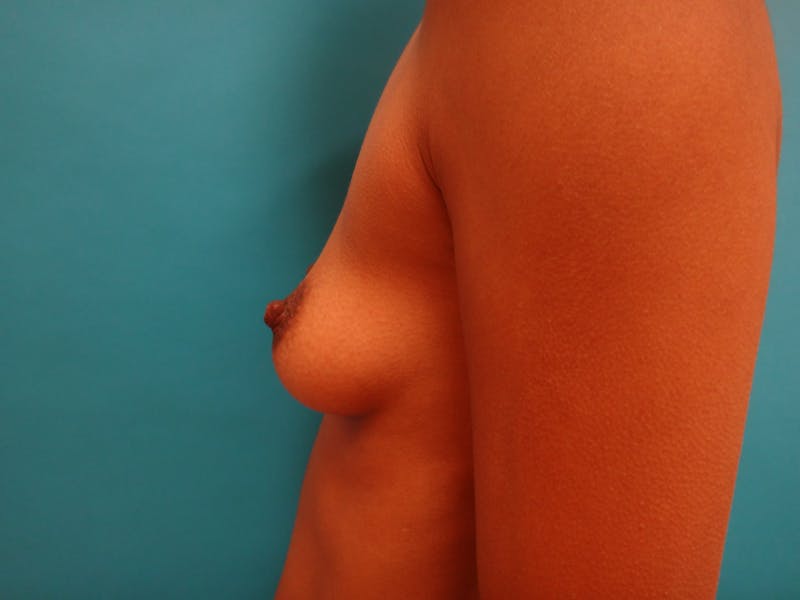 Breast Augmentation Before & After Gallery - Patient 366682 - Image 9