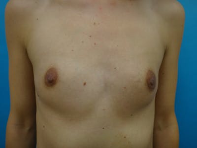 Breast Augmentation Before & After Gallery - Patient 367479 - Image 1