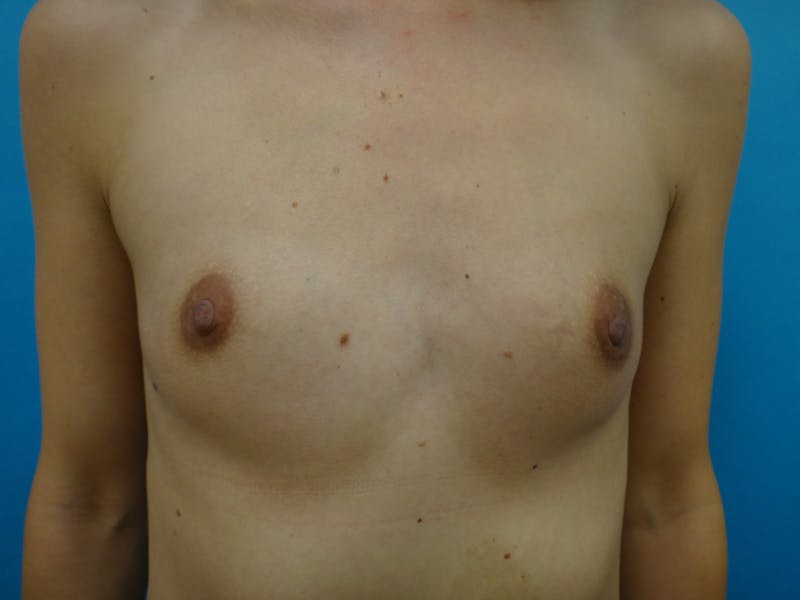 Breast Augmentation Before & After Gallery - Patient 367479 - Image 1