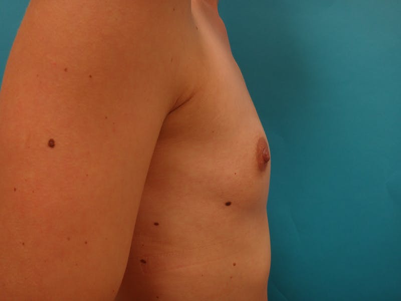 Breast Augmentation Before & After Gallery - Patient 367479 - Image 3