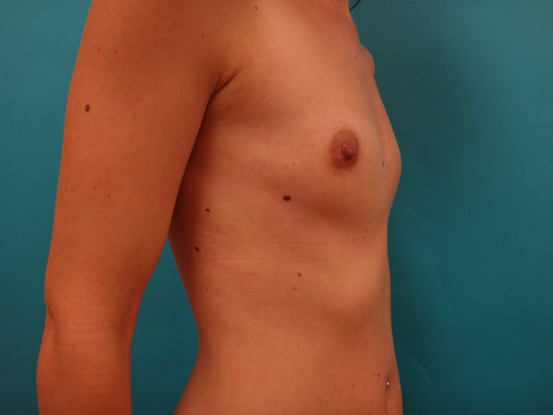 Breast Augmentation Before & After Gallery - Patient 367479 - Image 5