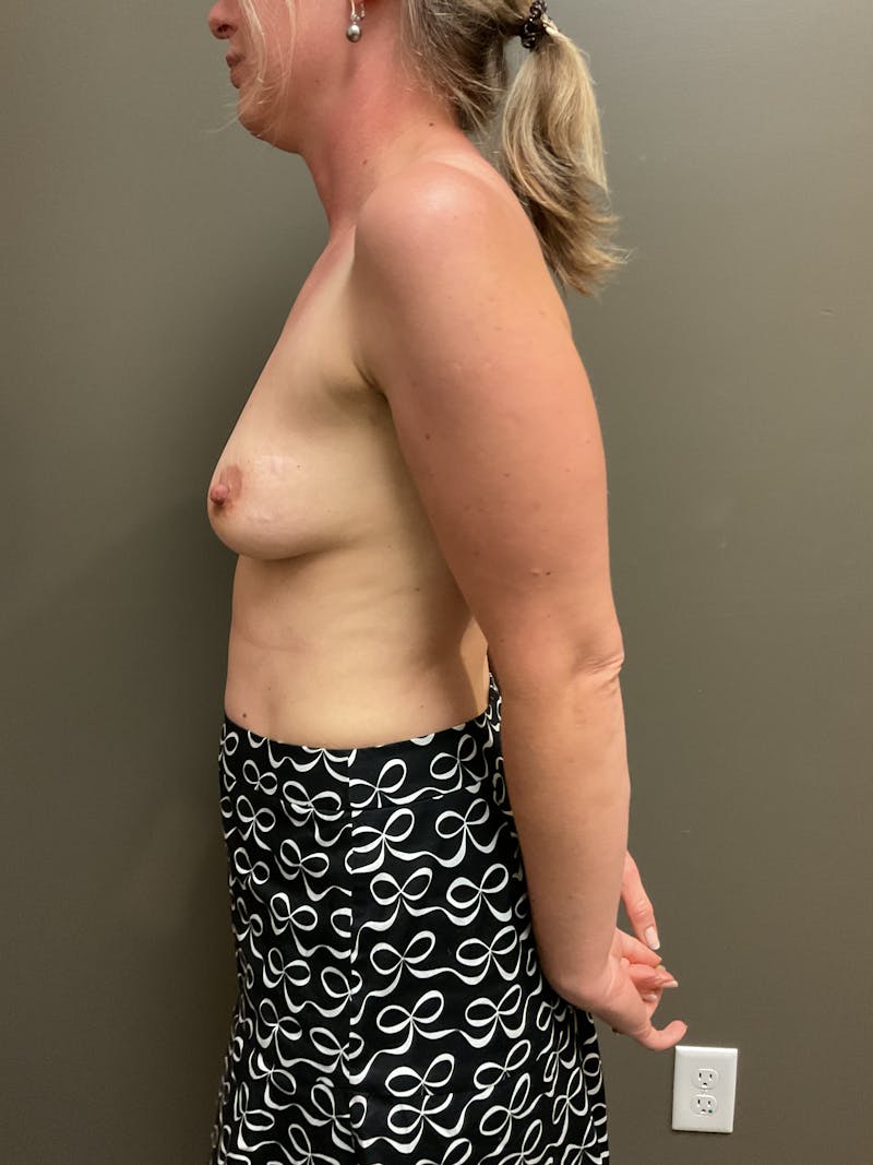 Breast Augmentation Before & After Gallery - Patient 211349 - Image 3