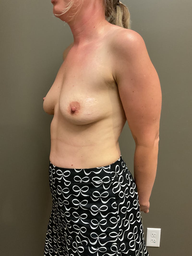 Breast Augmentation Before & After Gallery - Patient 211349 - Image 5
