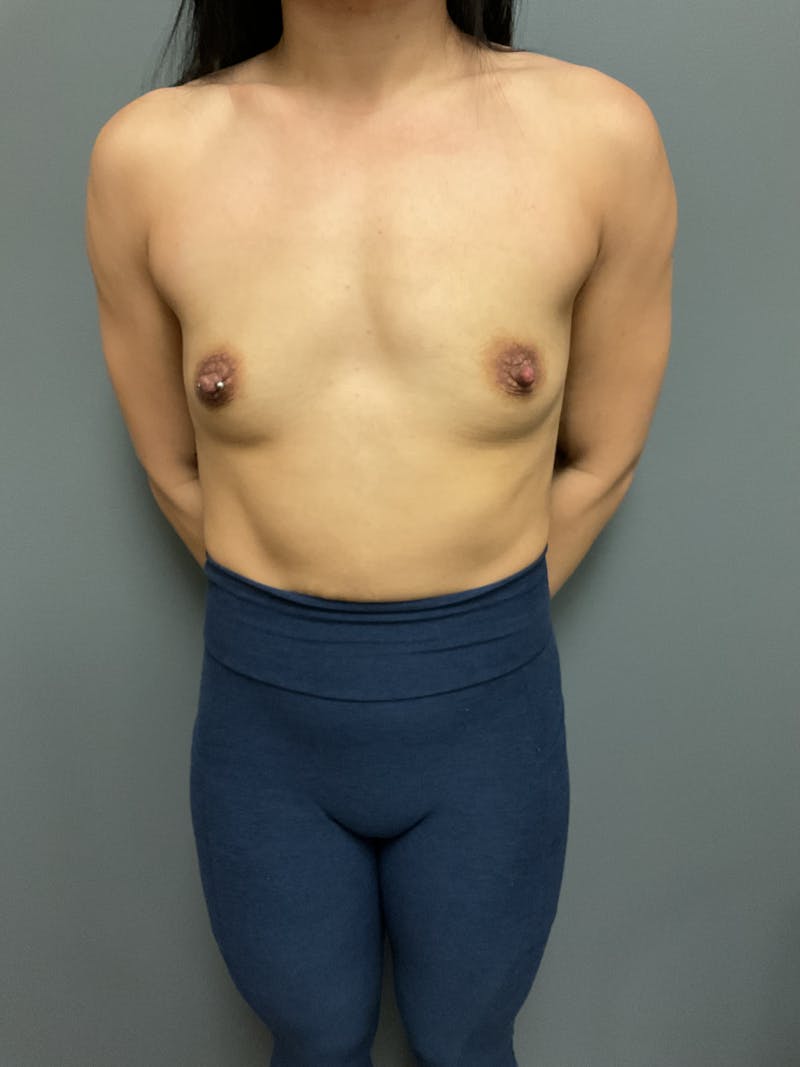 Breast Augmentation Before & After Gallery - Patient 271357 - Image 1