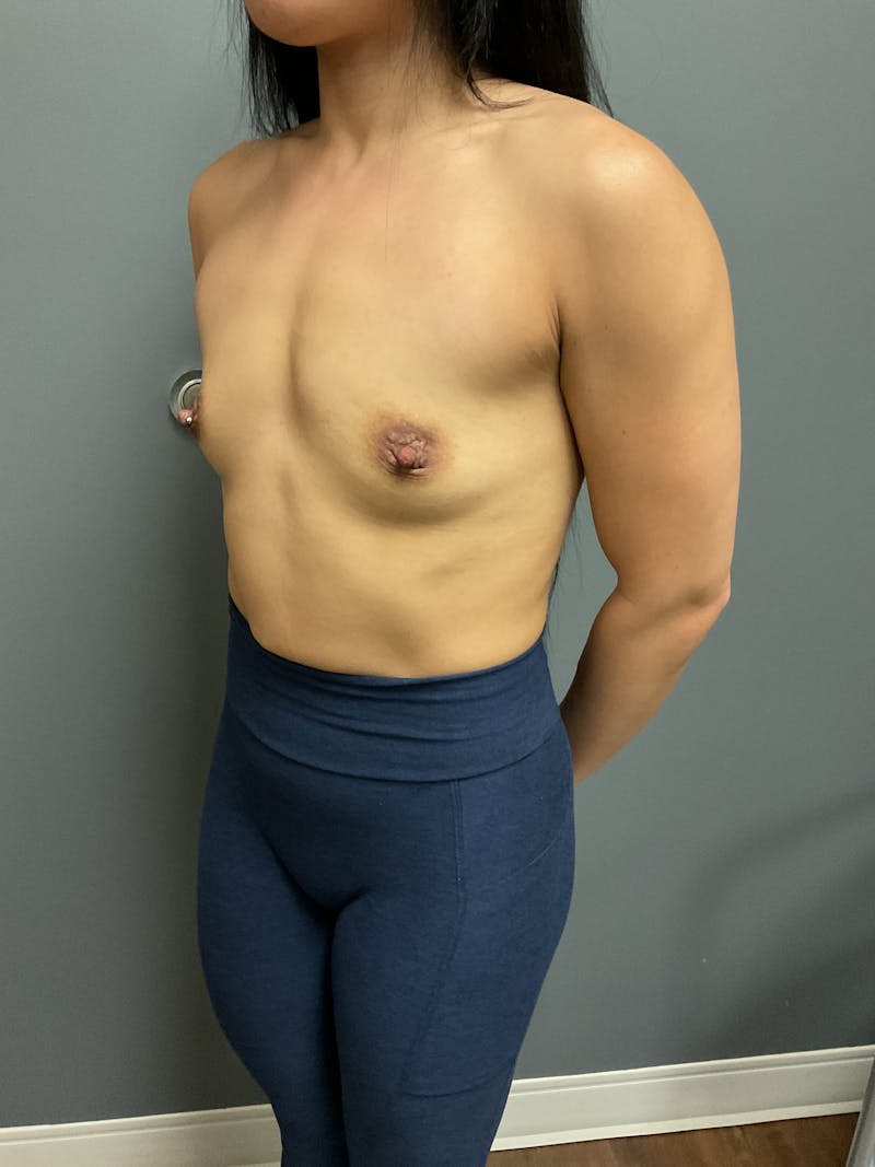 Breast Augmentation Before & After Gallery - Patient 271357 - Image 5