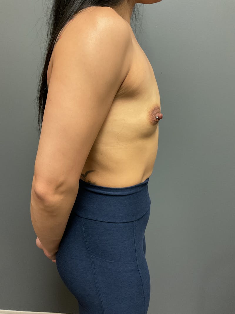 Breast Augmentation Before & After Gallery - Patient 271357 - Image 7