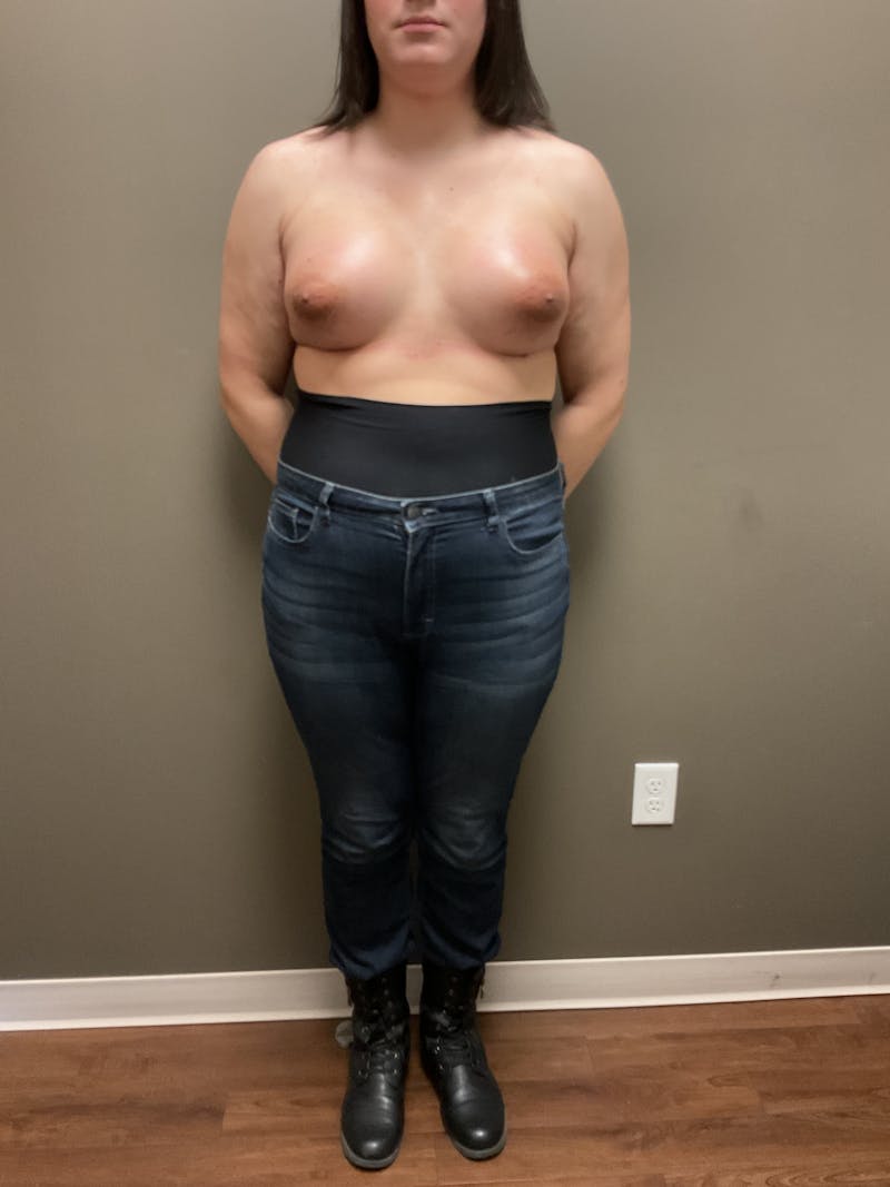 Breast Augmentation Before & After Gallery - Patient 482921 - Image 2