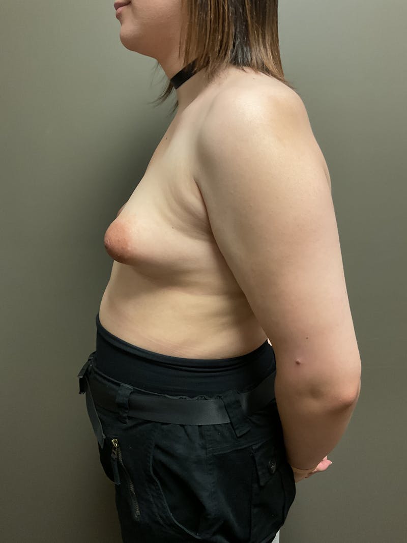 Breast Augmentation Before & After Gallery - Patient 482921 - Image 3