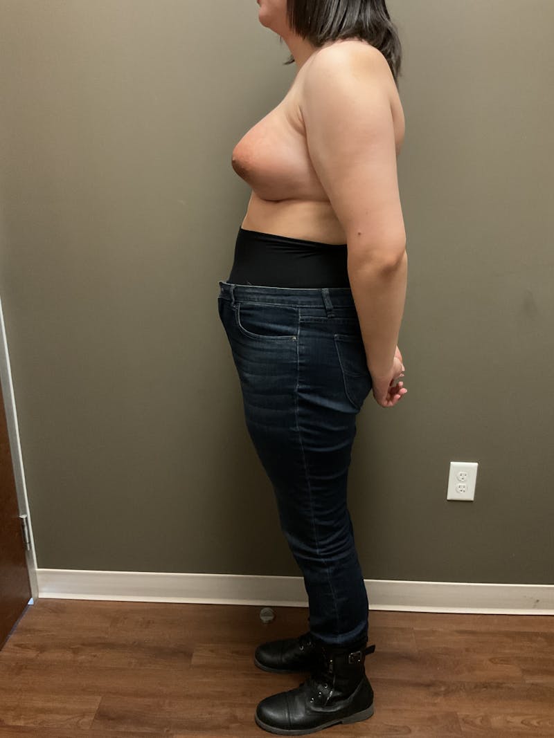 Breast Augmentation Before & After Gallery - Patient 482921 - Image 4