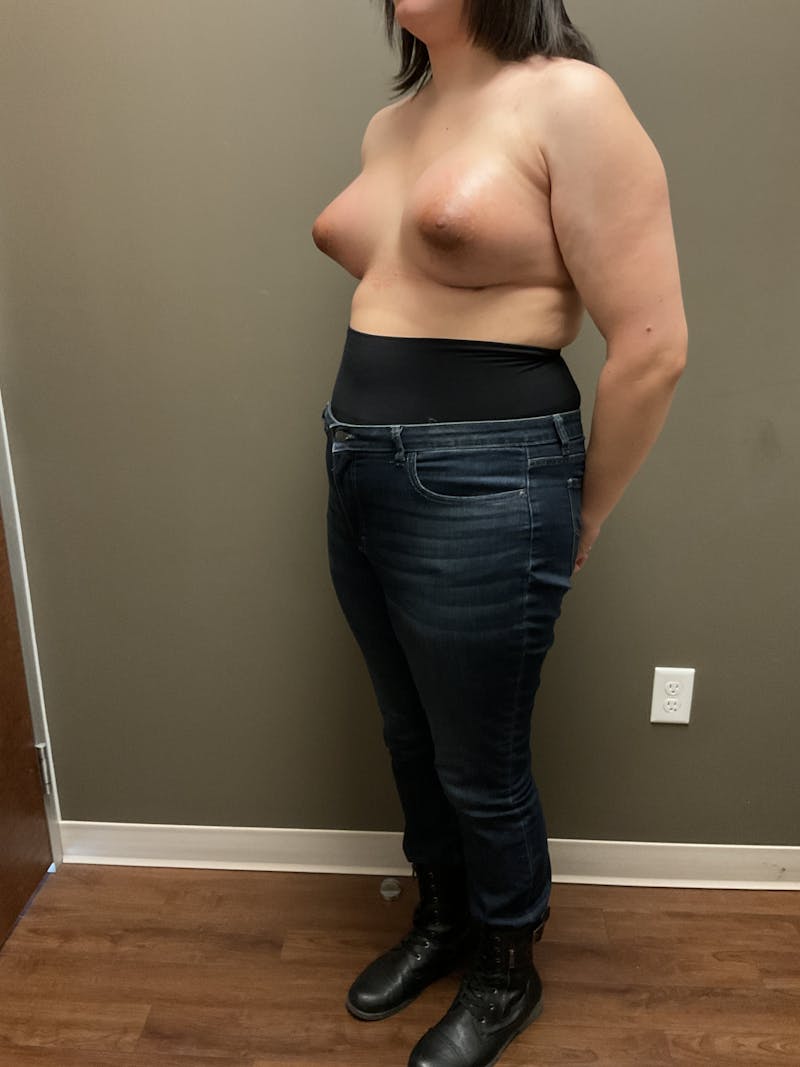 Breast Augmentation Before & After Gallery - Patient 482921 - Image 6