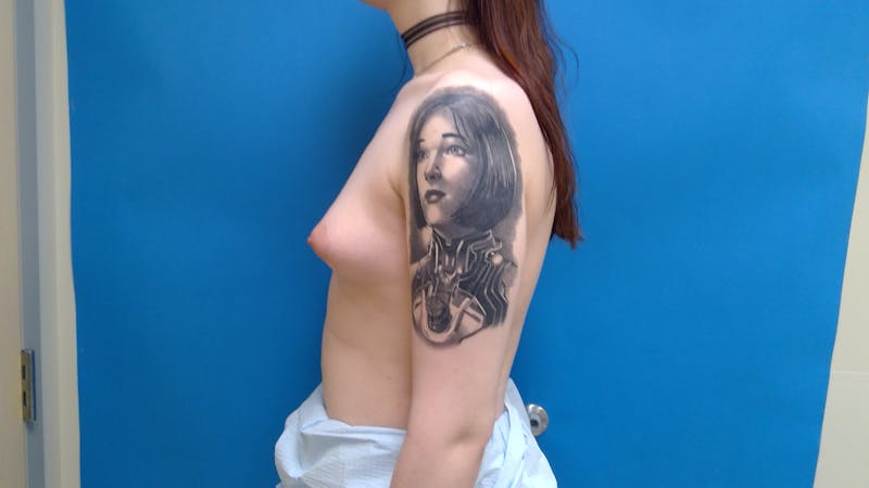 Breast Augmentation Before & After Gallery - Patient 989850 - Image 3