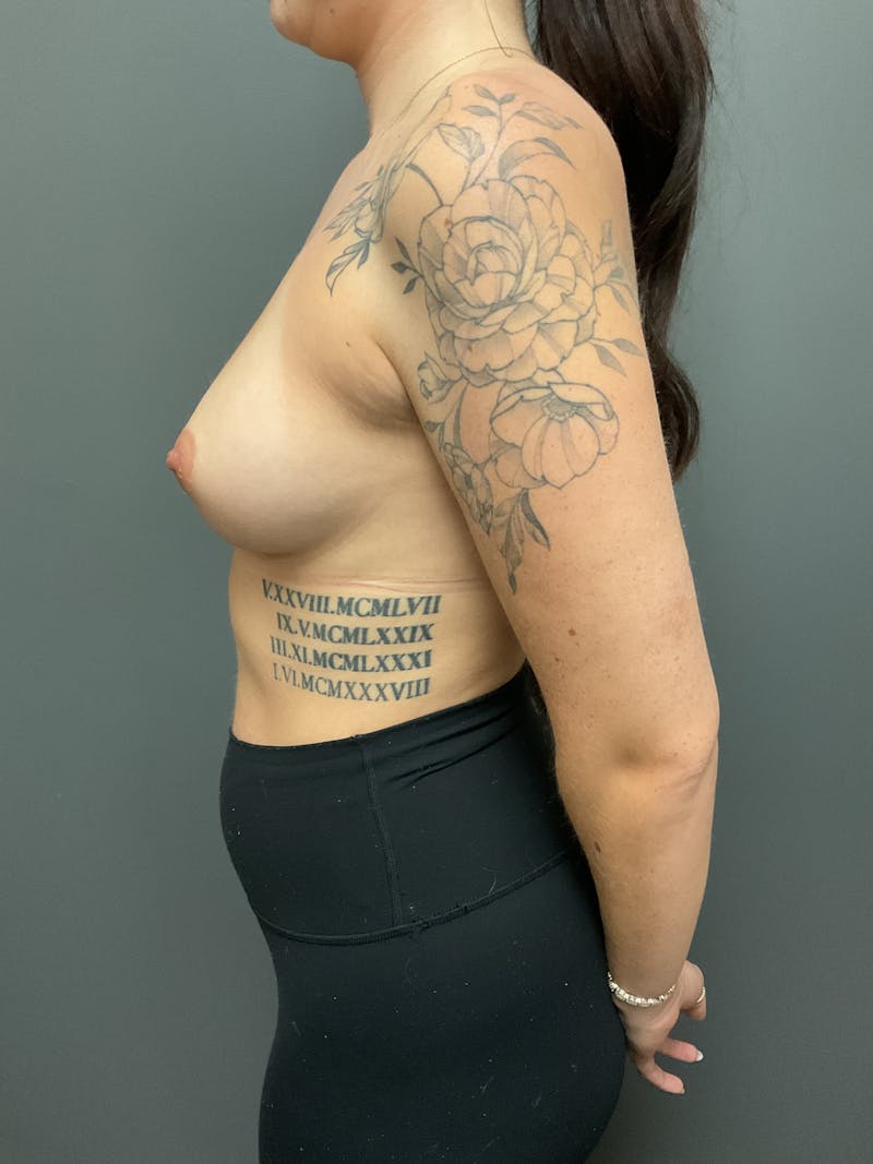 Breast Augmentation Before & After Gallery - Patient 247962 - Image 3