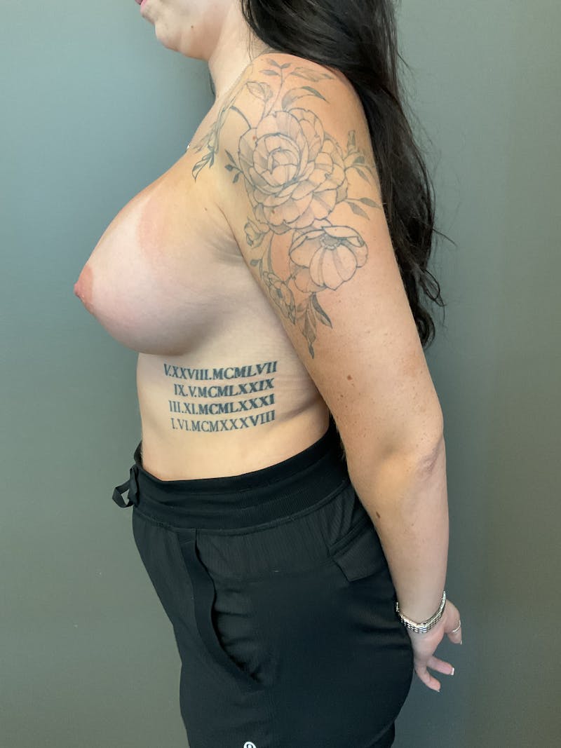 Breast Augmentation Before & After Gallery - Patient 247962 - Image 8