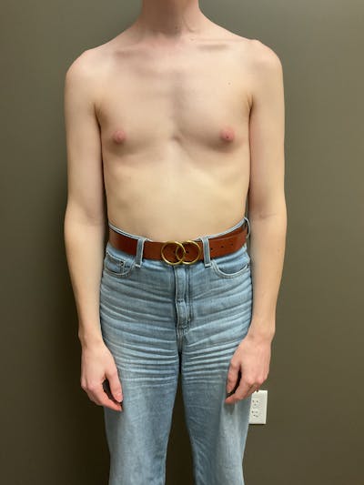 Breast Augmentation Before & After Gallery - Patient 331459 - Image 1