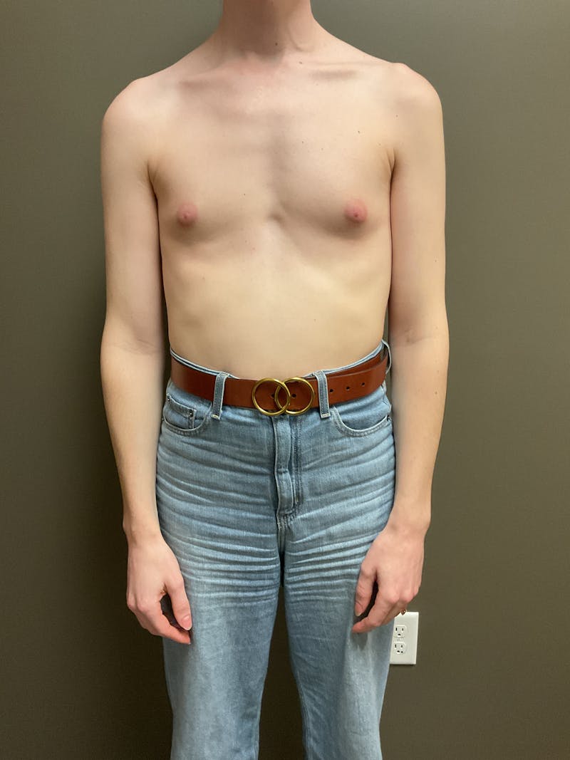 Breast Augmentation Before & After Gallery - Patient 331459 - Image 1